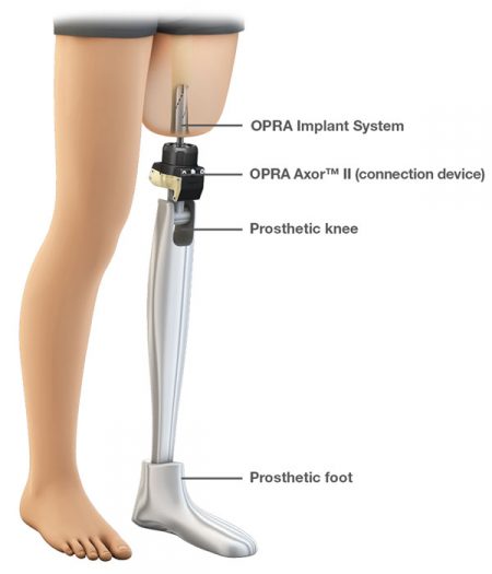 What You Need to Know About Osseointegration